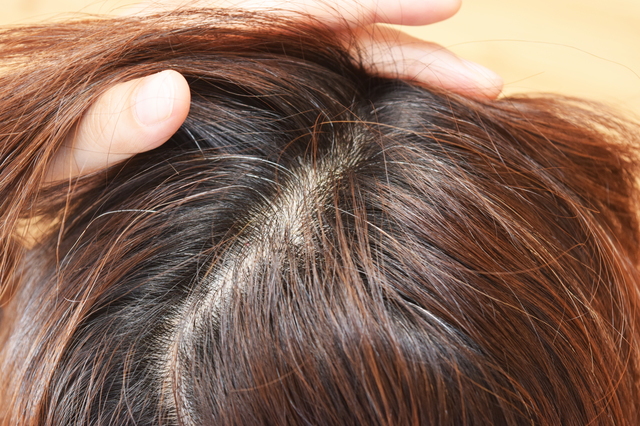 髪を抜く癖を解消する対処方法や対策・原因・特徴について